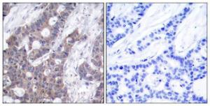 Immunohistochemical analysis of paraffin-embedded human breast carcinoma using Anti-Stathmin 1 (phospho Ser15) Antibody. The right hand panel represents a negative control, where the antibody was pre-incubated with the immunising peptide