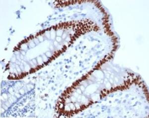 Immunohistochemical analysis of formalin-fixed, paraffin-embedded human colon adenocarcinoma using Anti-CDX2 Antibody [rCDX2/6921] at 2 µg/ml in PBS for 30  minutes at room temperature. Inset: PBS instead of the primary Antibody. Secondary Antibody negative control