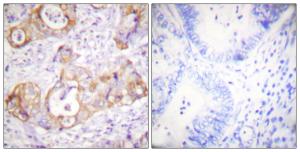 Immunohistochemical analysis of paraffin-embedded human colon carcinoma using Anti-Keratin 8 (phospho Ser432) Antibody. The right hand panel represents a negative control, where the antibody was pre-incubated with the immunising peptide.