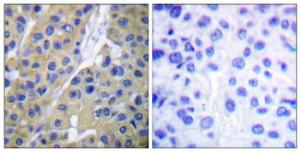 Immunohistochemical analysis of paraffin-embedded human breast carcinoma using Anti-Keratin 18 (phospho Ser33) Antibody. The right hand panel represents a negative control, where the antibody was pre-incubated with the immunising peptide