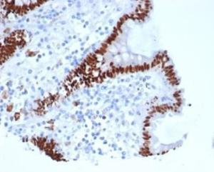 Immunohistochemical analysis of formalin-fixed, paraffin-embedded human colon carcinoma tissue using Anti-CDX2 Antibody [rCDX2/6921]