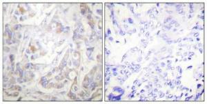 Immunohistochemical analysis of paraffin-embedded human breast cancer using Anti-Keratin 18 (phospho Ser33) Antibody 1:100 (4°C overnight). The right hand panel represents a negative control, where the antibody was pre-incubated with the immunising peptide