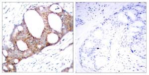 Immunohistochemical analysis of paraffin-embedded human breast carcinoma using Anti-GSK3 alpha (phospho Ser21) Antibody. The right hand panel represents a negative control, where the Antibody was pre-incubated with the immunising peptide