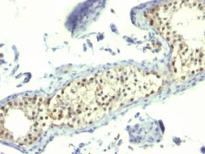 Immunohistochemical analysis of formalin-fixed, paraffin-embedded human testicular carcinoma using Anti-Thymidylate Synthase Antibody [TS106]