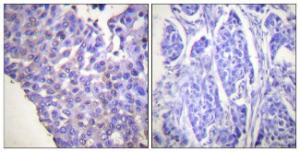 Immunohistochemical analysis of paraffin-embedded human breast carcinoma using Anti-Caldesmon (phospho Ser789) Antibody. The right hand panel represents a negative control, where the antibody was pre-incubated with the immunising peptide