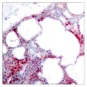 Immunohistochemical analysis of paraffin-embedded human breast carcinoma using Anti-ATF2 (phospho Ser62 or 44) Antibody