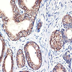 Immunohistochemistry analysis of paraffin-embedded human prostate cancer using Anti-Arg2 Antibody [ARC2391] (A305851) at a dilution of 1:100 (40X lens). Perform high pressure antigen retrieval with 10 mM citrate buffer pH 6.0 before commencing with IHC staining protocol