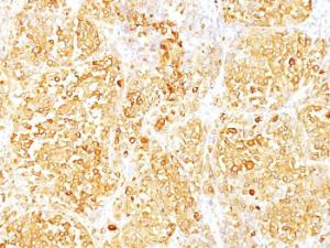 Immunohistochemical analysis of formalin-fixed, paraffin-embedded human melanoma using Anti-MelanA Antibody [M2-9E3]