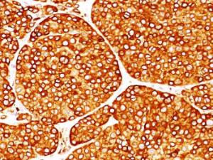 Immunohistochemical analysis of formalin-fixed, paraffin-embedded human melanoma using Anti-Tyrosinase Antibody [T311]