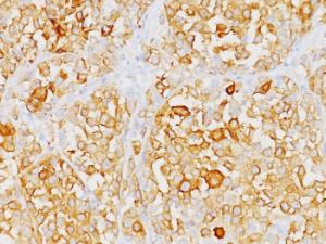 Immunohistochemical analysis of formalin-fixed, paraffin-embedded human melanoma using Anti-MelanA Antibody [M2-9E3]