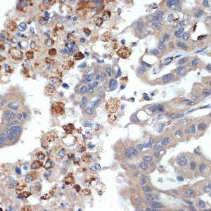 Immunohistochemistry analysis of paraffin-embedded human liver cancer using Anti-PRSS2 Antibody [ARC2453] (A307566) at a dilution of 1:100 (40x lens)