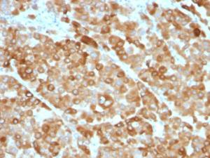 Immunohistochemical analysis of formalin-fixed, paraffin-embedded melanoma using Anti-Tyrosinase Antibody [OCA1/812]