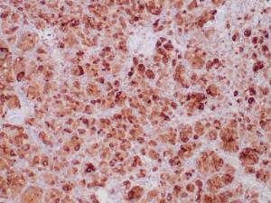 Immunohistochemical analysis of formalin-fixed, paraffin-embedded human paraganglioma tissue using Anti-SDHB Antibody [SDHB/6697R]