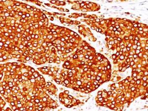 Immunohistochemical analysis of formalin-fixed, paraffin-embedded human melanoma using Anti-Tyrosinase Antibody [T311 + OCA1/812]