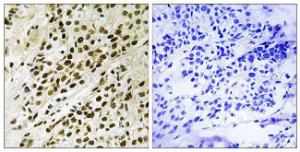 Immunohistochemical analysis of paraffin-embedded human breast carcinoma using Anti-MAPKAPK5 (phospho Thr182) Antibody. The right hand panel represents a negative control, where the antibody was pre-incubated with the immunising peptide