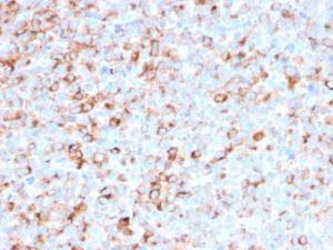 Immunohistochemical analysis of formalin-fixed, paraffin-embedded human melanoma using Anti-Tyrosinase Antibody [T311 + OCA1/812]