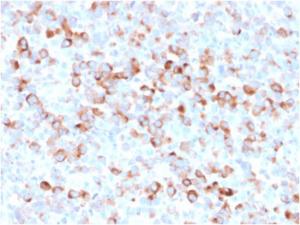 Immunohistochemical analysis of formalin-fixed, paraffin-embedded melanoma using Anti-Tyrosinase Antibody [rOCA1/812]