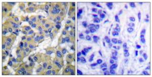 Immunohistochemical analysis of paraffin-embedded human breast carcinoma using Anti-Keratin 8 (phospho Ser73) Antibody. The right hand panel represents a negative control, where the antibody was pre-incubated with the immunising peptide.