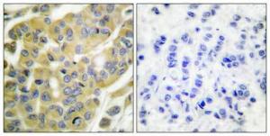 Immunohistochemical analysis of paraffin-embedded human breast cancer using Anti-Keratin 8 (phospho Ser73) Antibody 1:100 (4°C overnight). The right hand panel represents a negative control, where the antibody was pre-incubated with the immunising peptide.