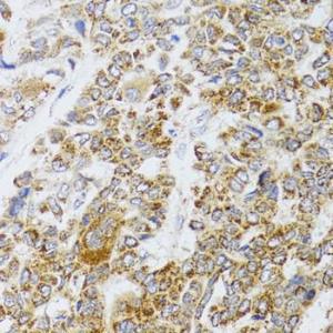 Immunohistochemistry analysis of paraffin-embedded human liver cancer using Anti-AIFM3 Antibody (A10467) at a dilution of 1:100 (40X lens). Perform microwave antigen retrieval with 10 mM PBS buffer pH 7.2 before commencing with IHC staining protocol