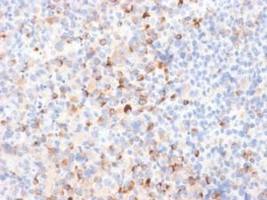 Immunohistochemical analysis of formalin-fixed, paraffin-embedded melanoma using Anti-Tyrosinase Antibody [TYR/2024R]