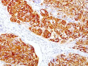 Immunohistochemical analysis of formalin-fixed, paraffin-embedded human melanoma using Anti-MelanA Antibody [DT101 + BC199]