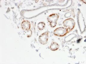 Immunohistochemical analysis of formalin-fixed, paraffin-embedded human breast carcinoma using Anti-GTF2H2C Antibody [PCRP-GTF2H2C-2C9]