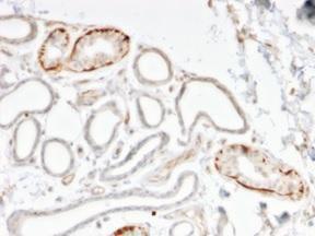 Immunohistochemical analysis of formalin-fixed, paraffin-embedded human breast carcinoma using Anti-GTF2H2C Antibody [PCRP-GTF2H2C-2C9]