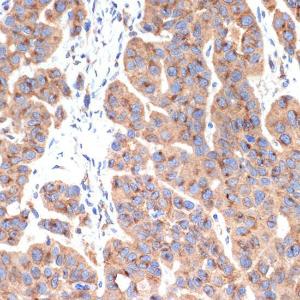 Immunohistochemistry analysis of paraffin-embedded human esophageal cancer using Anti-gamma Adaptin Antibody [ARC2440] (A308552) at a dilution of 1:100 (40X lens). Perform microwave antigen retrieval with 10 mM Tris/EDTA buffer pH 9.0 before commencing with IHC staining protocol