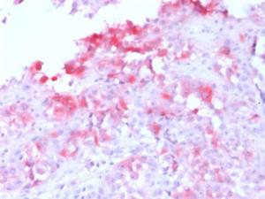 Immunohistochemical analysis of formalin-fixed, paraffin-embedded human melanoma using Anti-MelanA Antibody [MLANA/1761R]