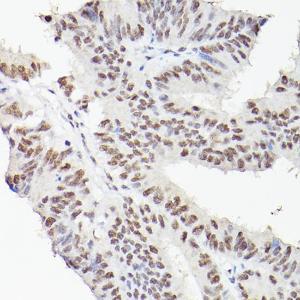 Immunohistochemistry analysis of paraffin-embedded human colon carcinoma tissue using Anti-LEO1 / RDL Antibody (A10520) at a dilution of 1:100 (40x lens). Perform high pressure antigen retrieval with 10 mM citrate buffer pH 6.0 before commencing with IHC staining protocol.