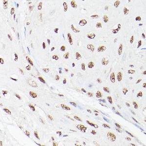 Immunohistochemistry analysis of paraffin-embedded human esophageal cancer using Anti-LEO1 / RDL Antibody (A10520) at a dilution of 1:100 (40x lens). Perform high pressure antigen retrieval with 10 mM citrate buffer pH 6.0 before commencing with IHC staining protocol.