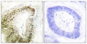 Immunohistochemical analysis of paraffin-embedded human colon carcinoma using Anti-LKB1 (phospho Ser428) Antibody. The right hand panel represents a negative control, where the Antibody was pre-incubated with the immunising peptide