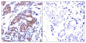 Immunohistochemical analysis of paraffin-embedded human breast carcinoma using Anti-Elk1 (phospho Ser383) Antibody The right hand panel represents a negative control, where the antibody was pre-incubated with the immunising peptide