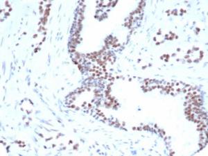 Immunohistochemical analysis of formalin-fixed, paraffin-embedded human prostate carcinoma tissue using Anti-FOXP1 Antibody [rFOXP1/6902]