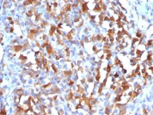 Immunohistochemical analysis of formalin-fixed, paraffin-embedded human melanoma using Anti-MelanA Antibody