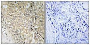 Immunohistochemical analysis of paraffin-embedded human prostate cancer using Anti-TPD52L3 Antibody 1:100 (4°C overnight). The right hand panel represents a negative control, where the antibody was pre-incubated with the immunising peptide.