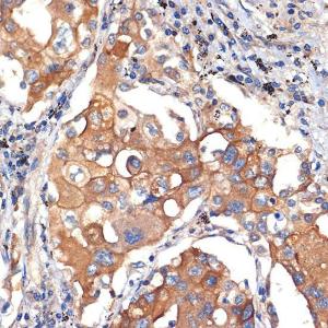 Immunohistochemistry analysis of paraffin-embedded human lung cancer using Anti-AGO3 Antibody [ARC2345] (A308562) at a dilution of 1:100 (40X lens). Perform microwave antigen retrieval with 10 mM Tris/EDTA buffer pH 9.0 before commencing with IHC staining protocol