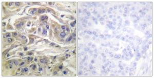 Immunohistochemical analysis of paraffin-embedded human breast carcinoma using Anti-RapGEF1 Antibody. The right hand panel represents a negative control, where the Antibody was pre-incubated with the immunising peptide