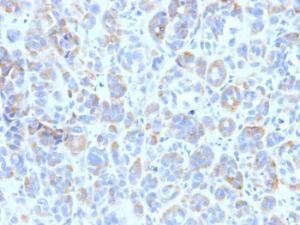 Immunohistochemical analysis of formalin-fixed, paraffin-embedded human melanoma using Anti-TRP1 Antibody [TYRP1/807]