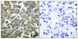 Immunohistochemical analysis of paraffin-embedded human breast carcinoma using Anti-WNK1 (phospho Thr58) Antibody. The right hand panel represents a negative control, where the antibody was pre-incubated with the immunising peptide