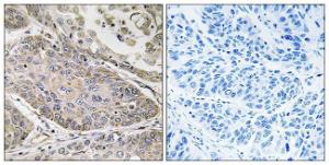 Immunohistochemical analysis of paraffin-embedded human lung carcinoma using Anti-PLA2G4E Antibody. The right hand panel represents a negative control, where the antibody was pre-incubated with the immunising peptide.