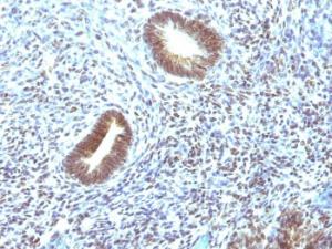 Immunohistochemical analysis of formalin-fixed, paraffin-embedded human uterine carcinoma using Anti-MAP3K1 Antibody [2F6]