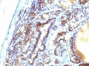 Immunohistochemical analysis of formalin-fixed, paraffin-embedded human thyroid carcinoma using Anti-MAP3K1 Antibody [2F6]