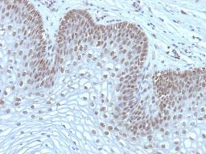 Immunohistochemical analysis of formalin-fixed, paraffin-embedded human cervical carcinoma using Anti-MAP3K1 Antibody [2F6]