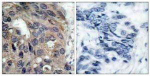 Immunohistochemical analysis of paraffin-embedded human breast carcinoma using Anti-Src (phospho Tyr529) Antibody. The right hand panel represents a negative control, where the antibody was pre-incubated with the immunising peptide