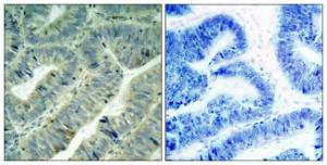 Immunohistochemical analysis of paraffin-embedded human colon carcinoma using Anti-Src (phospho Tyr418) Antibody. The right hand panel represents a negative control, where the antibody was pre-incubated with the immunising peptide