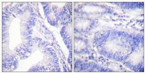 Immunohistochemical analysis of paraffin-embedded human colon cancer using Anti-Shc (phospho Tyr427) Antibody 1:100 (4 °C overnight). The right hand panel represents a negative control, where the antibody was pre-incubated with the immunising peptide