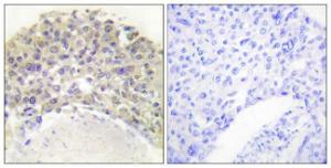 Immunohistochemical analysis of paraffin-embedded human breast carcinoma using Anti-Shc (phospho Tyr349) Antibody. The right hand panel represents a negative control, where the antibody was pre-incubated with the immunising peptide