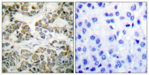 Immunohistochemical analysis of paraffin-embedded human breast cancer using Anti-Shc (phospho Tyr349) Antibody 1:100 (4°C overnight). The right hand panel represents a negative control, where the antibody was pre-incubated with the immunising peptide